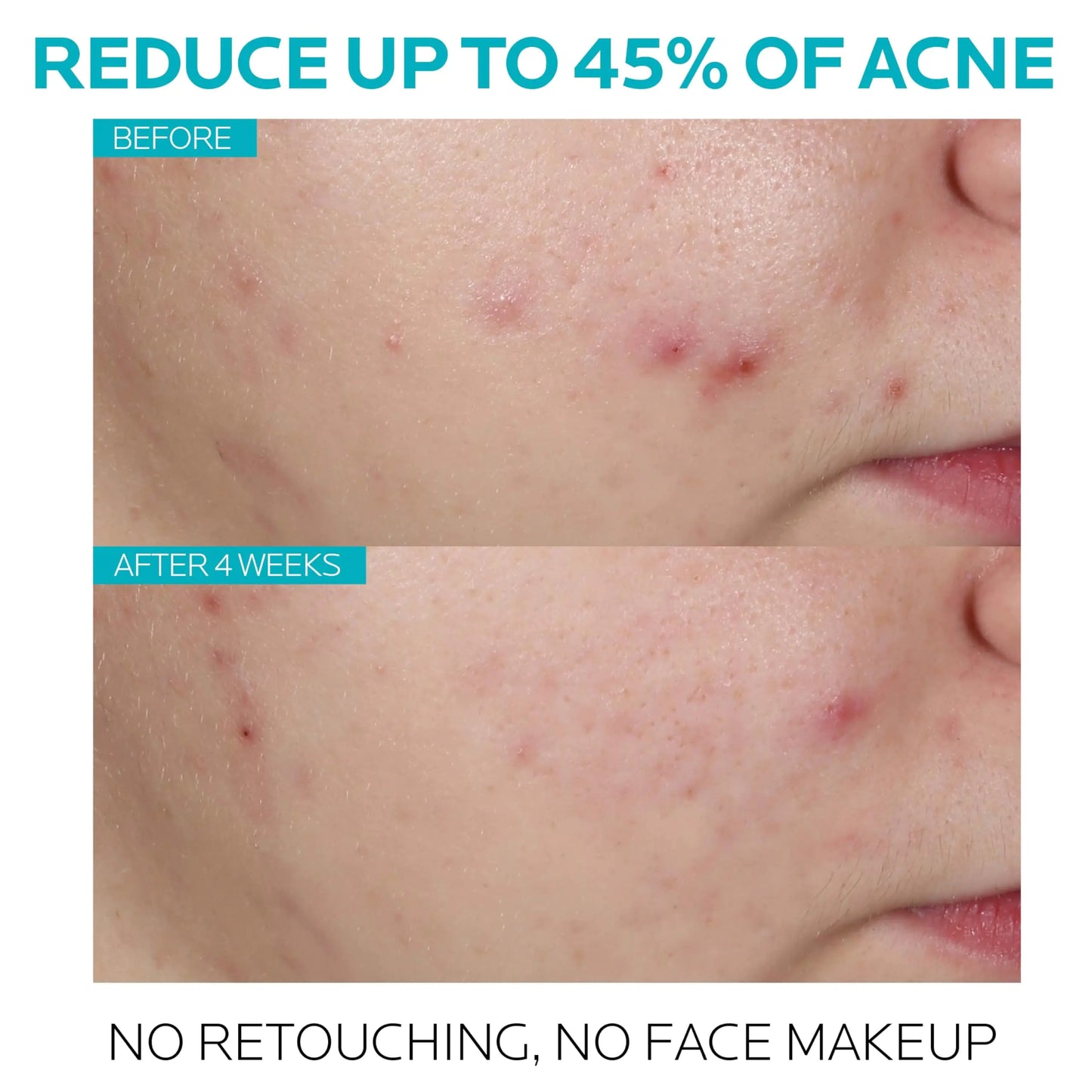 La Roche-Posay Effaclar Salicylic Acid Acne Treatment to Minimize Pores, Clear Acne Blemishes and Post Acne Marks